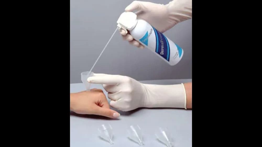 Dermafreeze Crioterapia Nitrogênio Líquido Verrugas Hpv