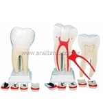 Dente Molar Ampliado em 8 Partes c/ Evolução de Carie - Anatomic - Portal do Médico