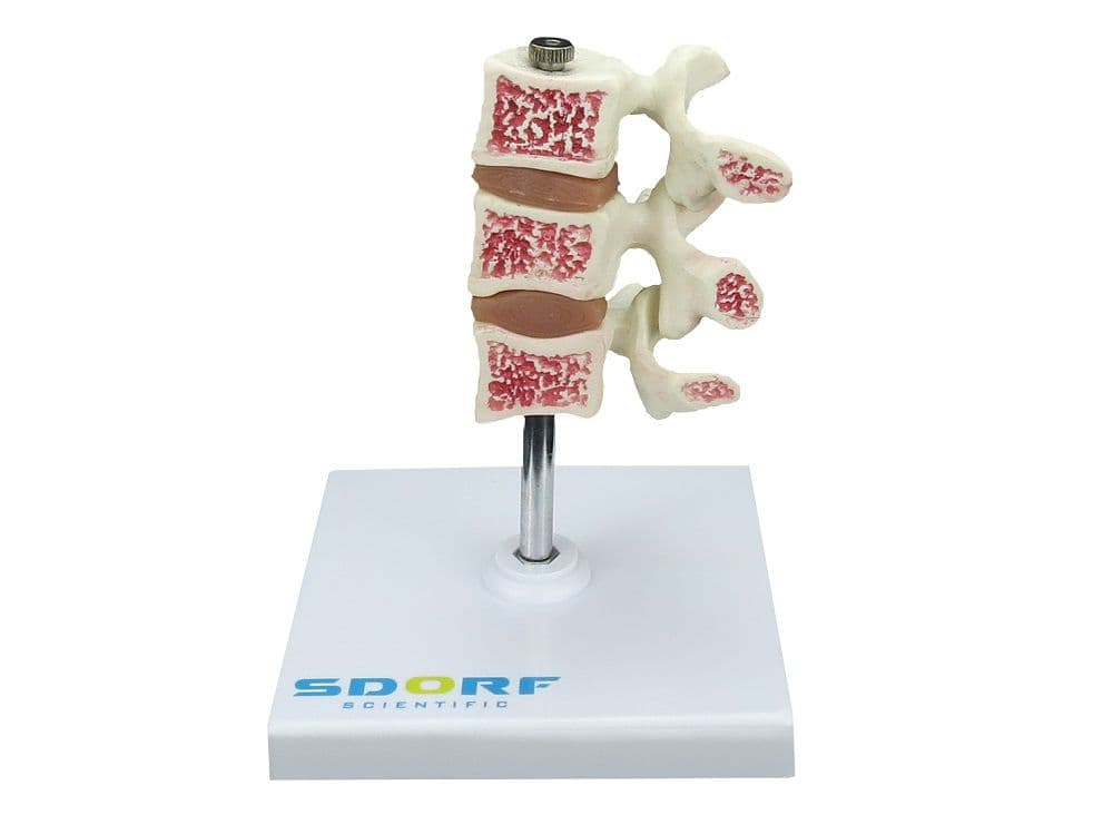 Modelo de Osteoporose - Portal do Médico